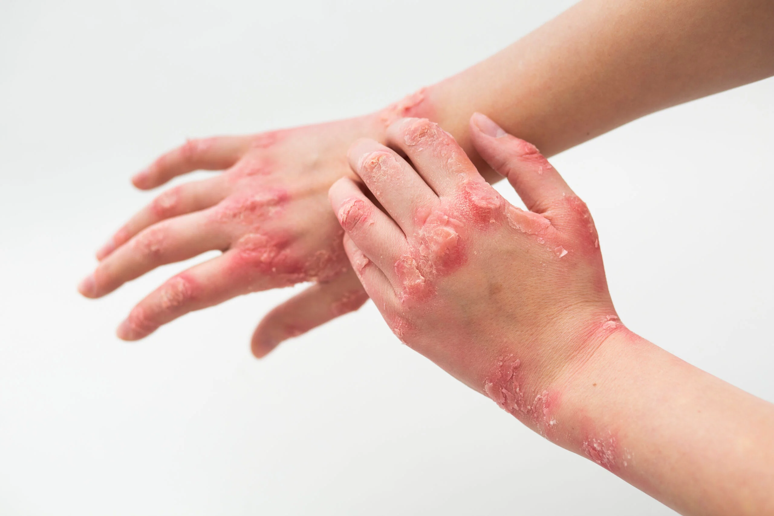 Fungal Infections