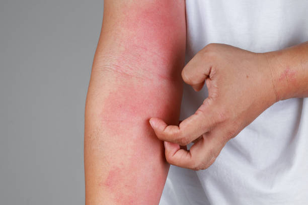Allergy & Itching