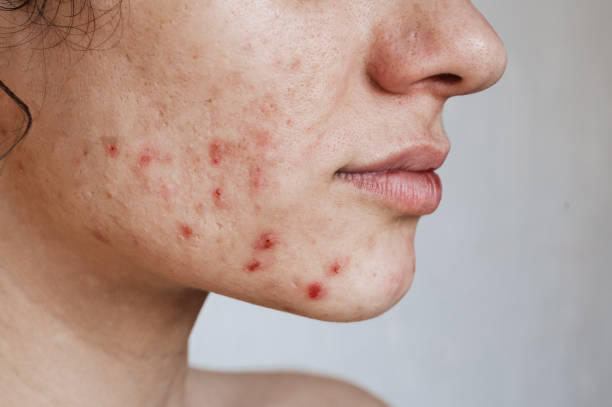 Acne & Pimples